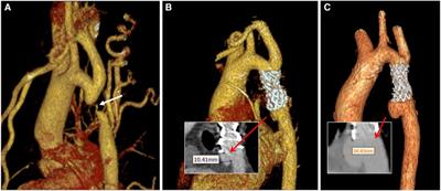 Hemodynamics in the treatment of pseudoaneurysm caused by extreme constriction of aortic arch with coated stent